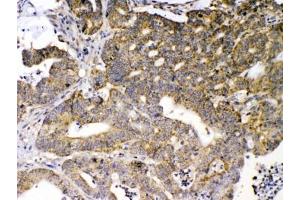 IHC testing of FFPE human intestinal cancer tissue with GAD65 antibody at 1ug/ml.