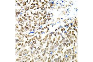 Immunohistochemistry of paraffin-embedded human lung cancer using PNKP antibody. (PNKP Antikörper)