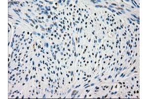 Immunohistochemical staining of paraffin-embedded Adenocarcinoma of colon tissue using anti-FRKmouse monoclonal antibody. (FRK Antikörper)