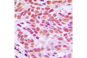 Immunohistochemical analysis of Histone H2B staining in human breast cancer formalin fixed paraffin embedded tissue section.