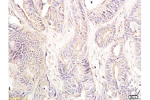 Formalin-fixed and paraffin embedded: human colon cancer tissue labeled with Anti-Dnmt-3-beta Polyclonal Antibody, Unconjugated (ABIN727623) at 1:600, followed by conjugation to the secondary antibody and DAB staining (DNMT3B Antikörper  (AA 1-80))