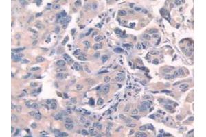 IHC-P analysis of Human Breast Cancer Tissue, with DAB staining. (Fibronectin Antikörper  (AA 313-607))