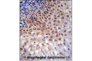 CCDC36 Antibody (C-term) (ABIN655696 and ABIN2845150) immunohistochemistry analysis in formalin fixed and paraffin embedded human esophageal carcinoma followed by peroxidase conjugation of the secondary antibody and DAB staining. (CCDC36 Antikörper  (C-Term))