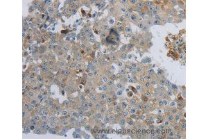 Immunohistochemistry of Human lung cancer using CKMT1A/CKMT1B Polyclonal Antibody at dilution of 1:100 (CKMT1A Antikörper)