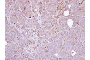 IHC-P Image Immunohistochemical analysis of paraffin-embedded SW480 xenograft , using Steroid sulfatase , antibody at 1:100 dilution. (STS Antikörper)
