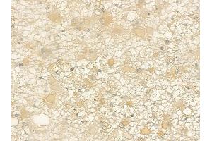 ABIN6261989 and ABIN6269005 at 1/100 staining human astrocytoma by IHC-P.