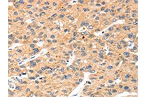 The image on the left is immunohistochemistry of paraffin-embedded Human liver cancer tissue using ABIN7192531(SLC8B1 Antibody) at dilution 1/20, on the right is treated with synthetic peptide.