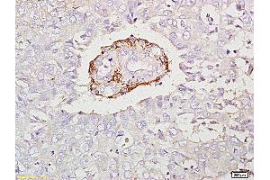 Formalin-fixed and paraffin embedded human laryngeal carcinoma labeled with Anti-IL-17C Polyclonal Antibody, Unconjugated (ABIN747983) at 1:200 followed by conjugation to the secondary antibody and DAB staining