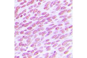 Immunohistochemical analysis of CDC25C staining in human breast cancer formalin fixed paraffin embedded tissue section.