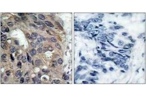 Immunohistochemistry analysis of paraffin-embedded human breast carcinoma, using Src (Phospho-Tyr529) Antibody. (Src Antikörper  (pTyr530))