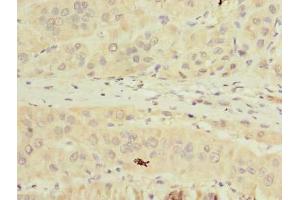Immunohistochemistry of paraffin-embedded human liver cancer using ABIN7173011 at dilution of 1:100 (TMPRSS6 Antikörper  (AA 98-301))