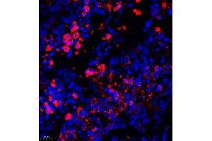 Immunofluorescence of paraffin embedded human lung cancer using AHSG (ABIN7073021) at dilution of 1:650 (400x lens) (Fetuin A Antikörper)