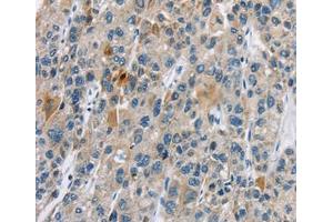 Immunohistochemical analysis of paraffin-embedded Human liver cancer tissue using at dilution 1/30. (CACNA2D1 Antikörper  (Internal Region))