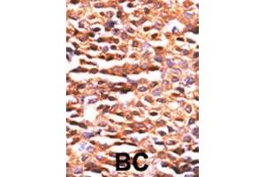 Formalin-fixed and paraffin-embedded human cancer tissue reacted with the primary antibody, which was peroxidase-conjugated to the secondary antibody, followed by DAB staining. (PPP2CA Antikörper  (N-Term))