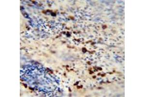 Immunohistochemistry analysis in human skin carcinoma (Formalin-fixed, Paraffin-embedded) using LCE1A  Antibody (C-term), followed by peroxidase conjugation of the secondary antibody and DAB staining. (LCE1A Antikörper  (C-Term))