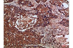 Immunohistochemical analysis of paraffin-embedded Human-lung-cancer, antibody was diluted at 1:100 (FLT4 Antikörper  (AA 720-760))