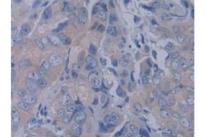 Detection of YARS in Human Breast cancer Tissue using Polyclonal Antibody to Tyrosyl tRNA Synthetase (YARS) (YARS Antikörper  (AA 2-528))