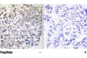 Immunohistochemical analysis of paraffin-embedded human breast carcinoma tissue using RAPGEF1 polyclonal antibody . (GRF2 Antikörper)