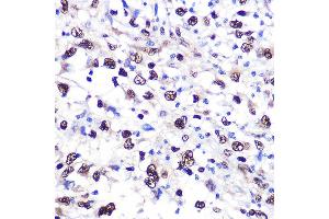 Immunohistochemistry of paraffin-embedded human liver cancer using NCL Rabbit pAb (ABIN6128392, ABIN6144411, ABIN6144412 and ABIN6221613) at dilution of 1:100 (40x lens). (Nucleolin Antikörper  (AA 461-710))