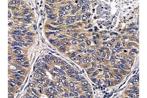 ABIN6258527 and ABIN6274787 at 1/100 staining human lung cancer and adjacent non-tumor tissue by IHC-P. (ABHD11 Antikörper  (C-Term))
