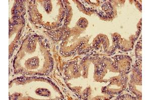 Immunohistochemistry of paraffin-embedded human prostate cancer using ABIN7164978 at dilution of 1:100 (PSMB4 Antikörper  (AA 46-264))