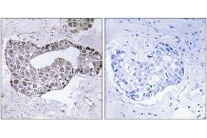 Immunohistochemistry analysis of paraffin-embedded human breast carcinoma tissue, using GATA1 (Ab-142) Antibody.