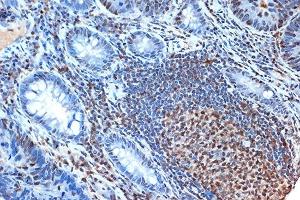 Immunohistochemistry of paraffin-embedded human colon carcinoma using FEN-1 Rabbit mAb (ABIN7267215) at dilution of 1:100 (40x lens). (FEN1 Antikörper)