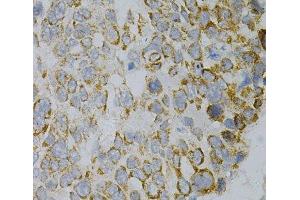 Immunohistochemistry of paraffin-embedded Human esophageal cancer using GNAO1 Polyclonal Antibody at dilution of 1:100 (40x lens). (GNAO1 Antikörper)