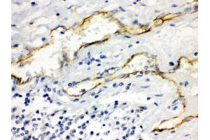 Anti- Aquaporin 1 Picoband antibody, IHC(P) IHC(P): Human Intestinal Cancer Tissue (Aquaporin 1 Antikörper  (C-Term))