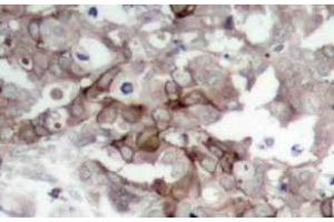 Immunohistochemistry analysis of Cortactin Antibody in paraffin-embedded human breast carcinoma tissue. (Cortactin Antikörper)