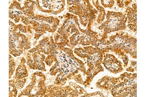 ABIN6265828 and ABIN6269033 at 1/100 staining Human kidney cancer by IHC-P. (TYR Antikörper  (C-Term))
