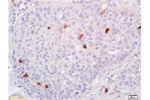 Formalin-fixed and paraffin embedded human lung carcinoma labeled with Anti-ADAMTS1 Polyclonal Antibody, Unconjugated (ABIN673404) at 1:200 followed by conjugation to the secondary antibody and DAB staining. (ADAMTS1 Antikörper  (AA 851-967))