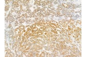 ABIN6258586 and ABIN6274433 at 1/100 staining human renal cell carcinoma by IHC-P.