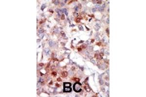 Formalin-fixed and paraffin-embedded human cancer tissue reacted with the primary antibody, which was peroxidase-conjugated to the secondary antibody, followed by AEC staining. (AKT3 Antikörper  (AA 88-118))