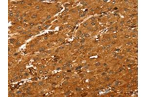 The image on the left is immunohistochemistry of paraffin-embedded Human liver cancer tissue using ABIN7189594(ABCC9 Antibody) at dilution 1/35, on the right is treated with synthetic peptide. (ABCC9 Antikörper)