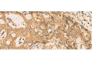 Immunohistochemistry of paraffin-embedded Human cervical cancer tissue using CNST Polyclonal Antibody at dilution of 1:70(x200)