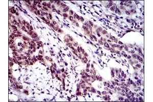 Immunohistochemical analysis of paraffin-embedded esophageal cancer tissues using CLGN mouse mAb with DAB staining. (Calmegin Antikörper  (AA 249-405))
