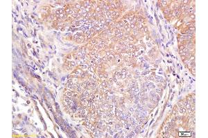 Formalin-fixed and paraffin embedded human breast carcinoma labeled with Anti Wnt6 Polyclonal Antibody, Unconjugated (ABIN762926) at 1:200 followed by conjugation to the secondary antibody and DAB staining (WNT6 Antikörper  (AA 281-365))