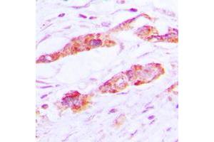 Immunohistochemical analysis of CLIC4 staining in human lung cancer formalin fixed paraffin embedded tissue section.
