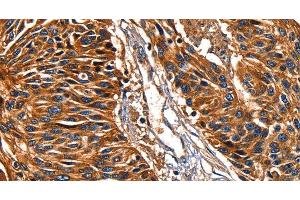 Immunohistochemistry of paraffin-embedded Human esophagus cancer tissue using Galectin 8 Polyclonal Antibody at dilution 1:50 (LGALS8 Antikörper)