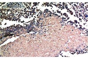 Immunohistochemistry of paraffin-embedded Human lung carcinoma tissue using AKT1 Monoclonal Antibody at dilution of 1:200. (AKT1 Antikörper)