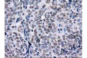 Immunohistochemical staining of paraffin-embedded Adenocarcinoma of colon tissue using anti-L1CAMmouse monoclonal antibody. (L1CAM Antikörper)