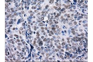 Immunohistochemical staining of paraffin-embedded Adenocarcinoma of colon tissue using anti-L1CAMmouse monoclonal antibody.