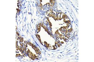 Immunohistochemistry of paraffin-embedded human prostate cancer using KLK3 Rabbit pAb (ABIN3022794, ABIN3022795, ABIN3022796 and ABIN6219231) at dilution of 1:100 (40x lens). (Prostate Specific Antigen Antikörper  (AA 1-100))