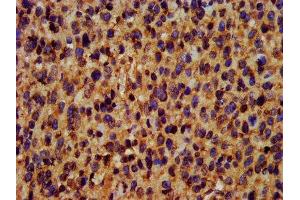 IHC image of ABIN7173439 diluted at 1:400 and staining in paraffin-embedded human glioma performed on a Leica BondTM system. (TRIM35 Antikörper  (AA 1-206))