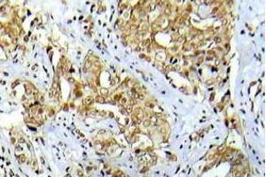 Immunohistochemistry analysis Phospho-Abl1 antibody in paraffin-embedded human breast carcinoma tissue. (ABL1 Antikörper  (pTyr412))