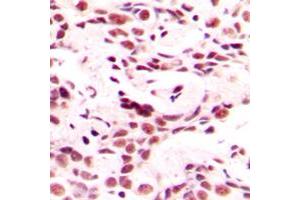 Immunohistochemical analysis of HOXB9 staining in human breast cancer formalin fixed paraffin embedded tissue section. (HOXB9 Antikörper  (C-Term))