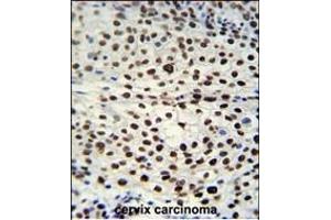 HNRB Antibody (N-term) (ABIN651713 and ABIN2840371) immunohistochemistry analysis in formalin fixed and raffin embedded human cervix carcinoma followed by peroxidase conjugation of the secondary antibody and DAB staining. (HNRNPAB Antikörper  (N-Term))