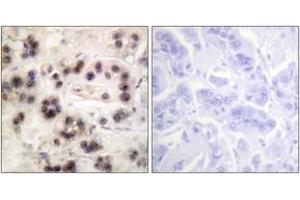 Immunohistochemistry analysis of paraffin-embedded human breast carcinoma, using p63 (Phospho-Ser455) Antibody. (TCP1 alpha/CCTA Antikörper  (pSer455))