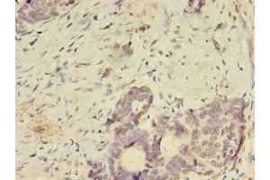 Immunohistochemistry of paraffin-embedded human gastric cancer using ABIN7166144 at dilution of 1:100 (SPIRE2 Antikörper  (AA 79-388))